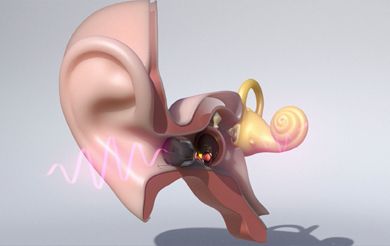 Eine Darstellung eines Ohres, das mit der von außen unsichtbaren Hörlösung von Vibrosonic ausgestattet ist